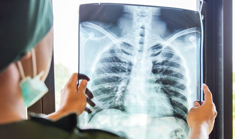 Tomografilerde ortaya çıktı: Gizli akciğer kanseri vakaları pandemide 5 kat arttı