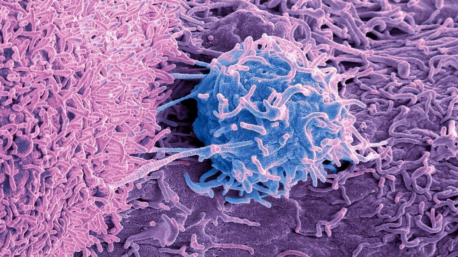 072039029 tumorlerde yasayan mikroplar kanserin nedeni ve tedavisiyle ilgili ne tur ipuclari veriyor 1
