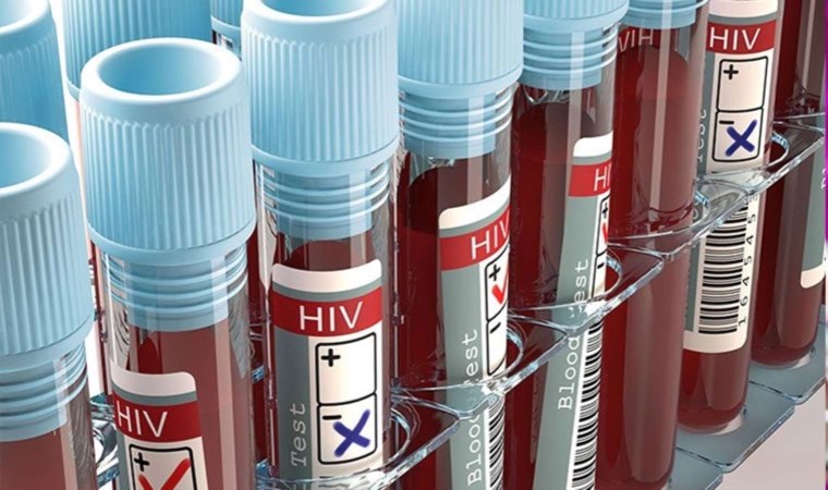 HIV virüsü nedir, belirtileri nelerdir? HIV Enfeksiyonu (AIDS) nasıl bulaşır?