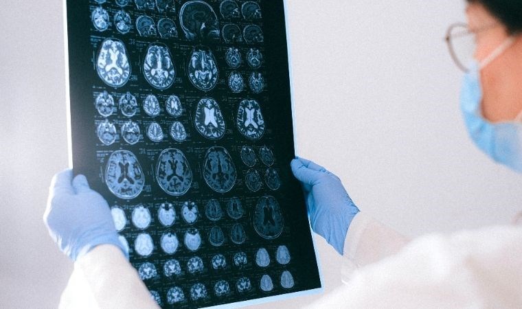 26 yıllık Nörogörüntüleme verileri yapay zeka ile sınıflandırıldı