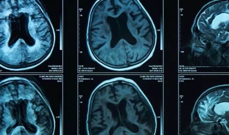 Prof. Cengiz Kuday uyardı: Beyin tümörünün belirtileri her hastada farklı